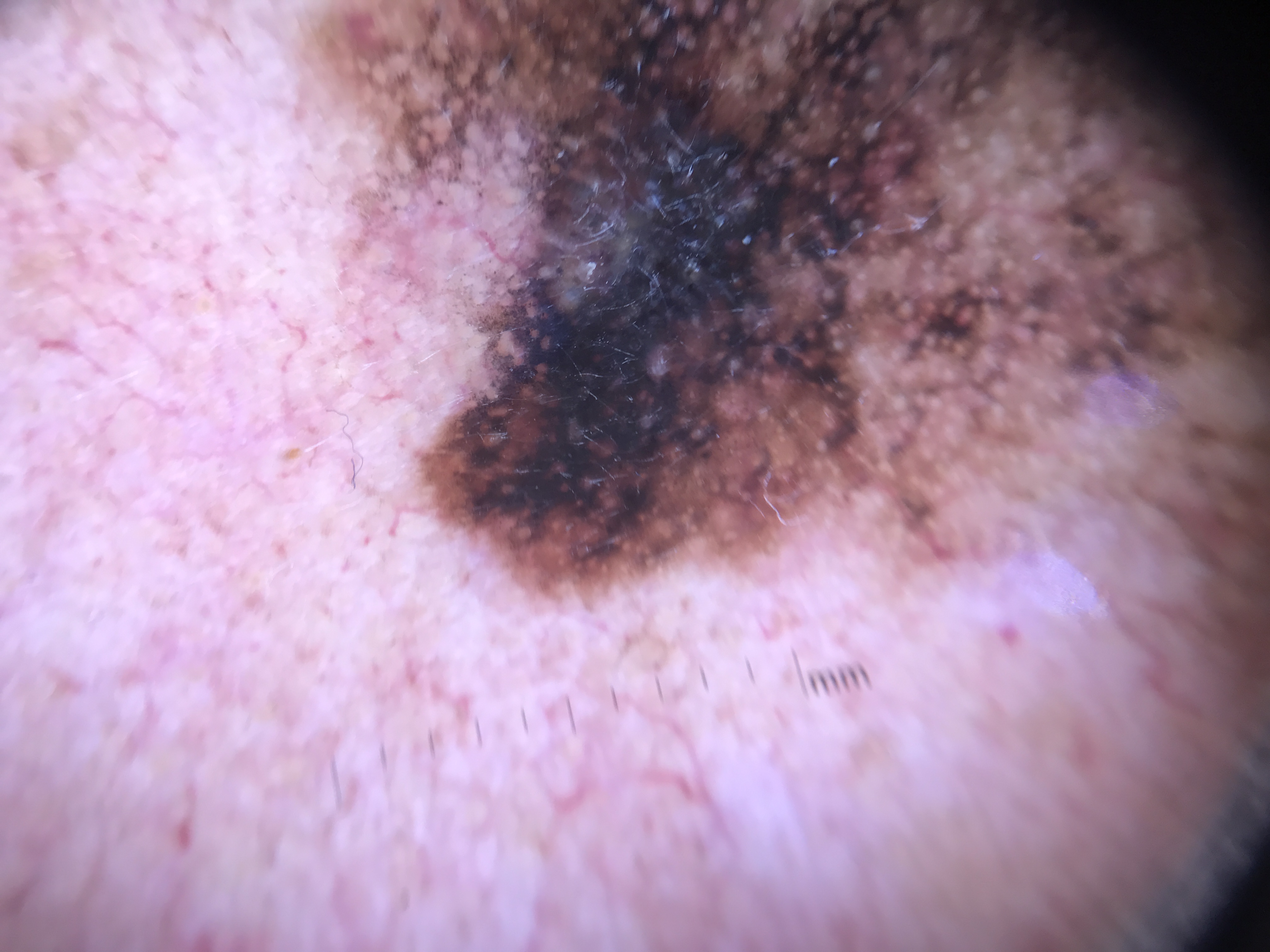 Angulated lines forming zig-zag pattern and rhomboid structures in lentigo maligna