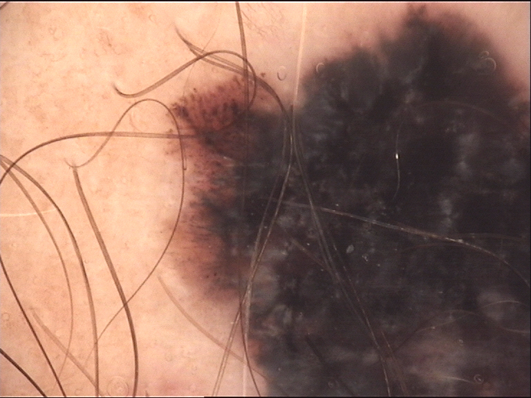 Clinical vignette: A 58-year-old man with a history of cutaneous melanoma excised 3 years ago presents with a new 6 mm blue-black nodule on his scalp that appeared 4 months ago and has been growing.