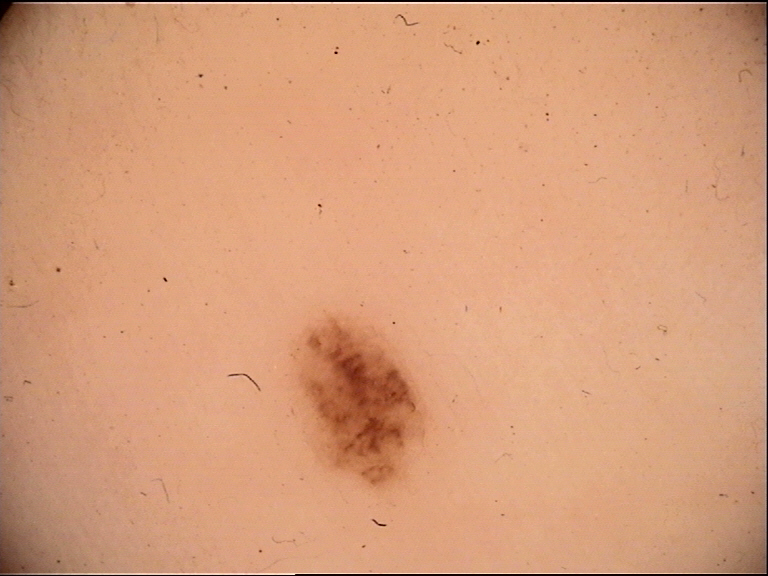 Feature exemplar: Histopathologic correlation of pigment network showing rete ridges with melanin at DEJ