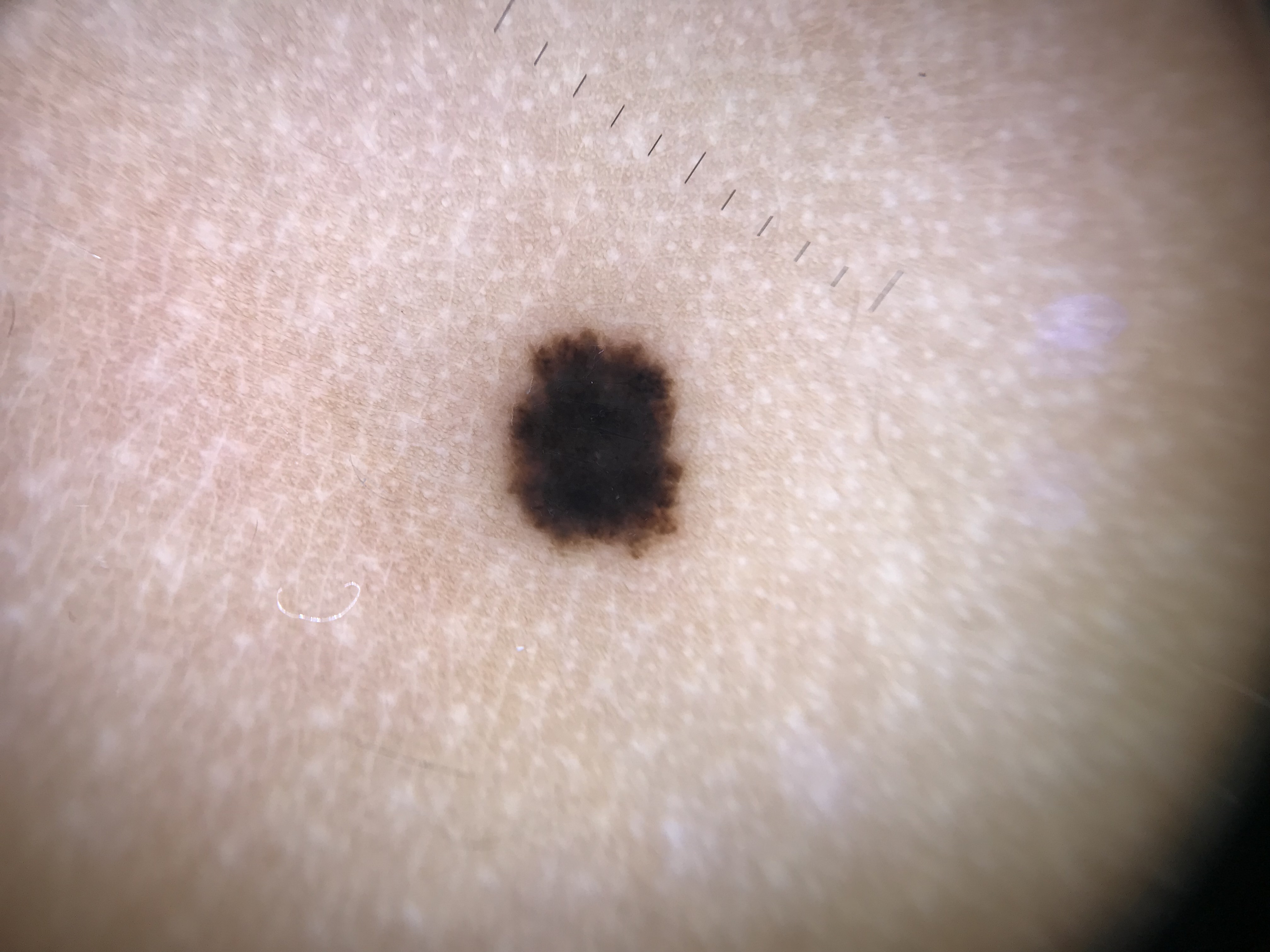 Melanocytic Nevus example 1