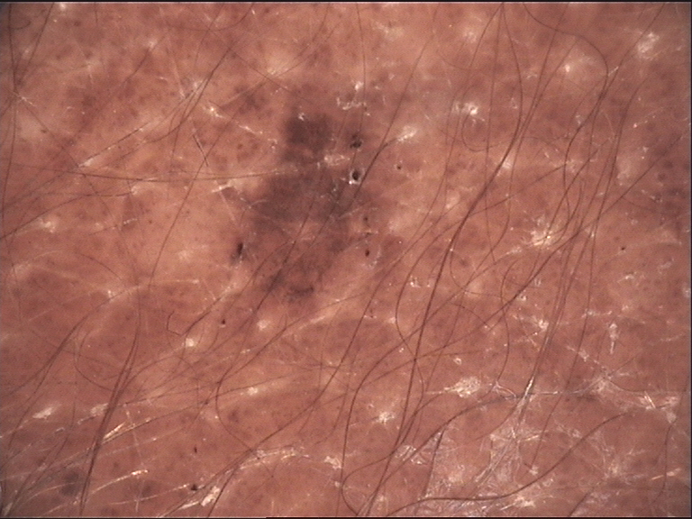 Melanocytic Nevus example 2