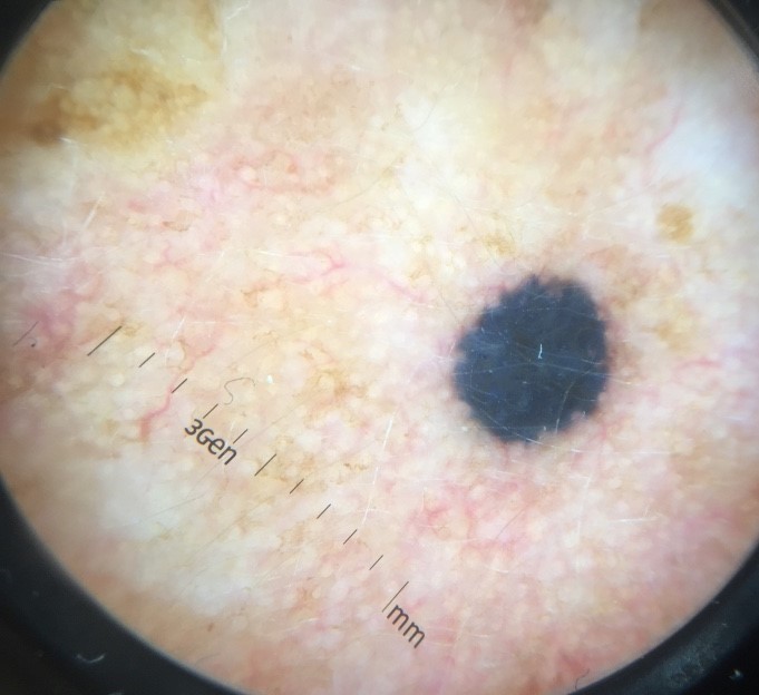 Melanocytic Nevus example 3
