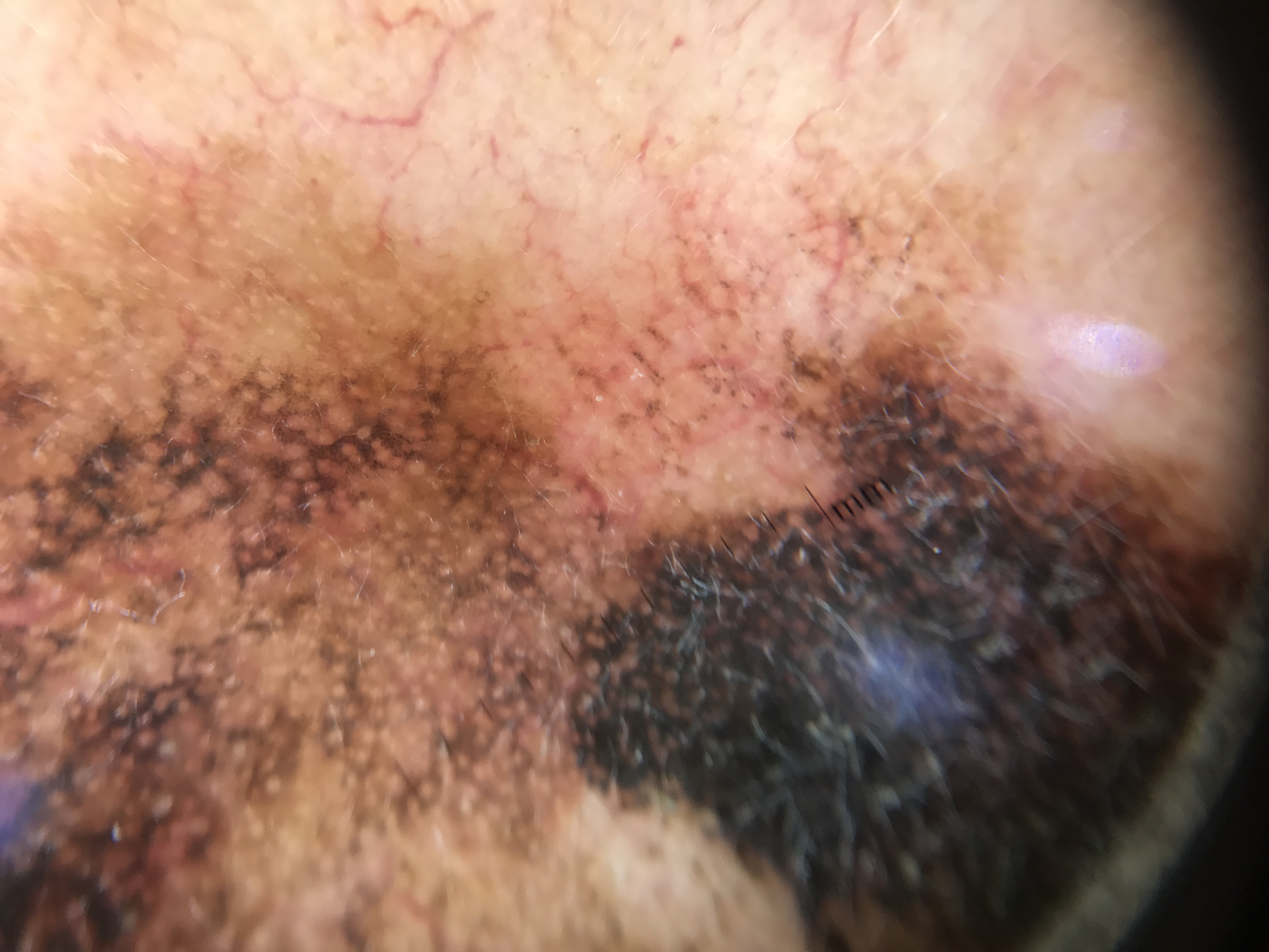 Facial skin pseudonetwork with brown structureless areas interrupted by follicular openings