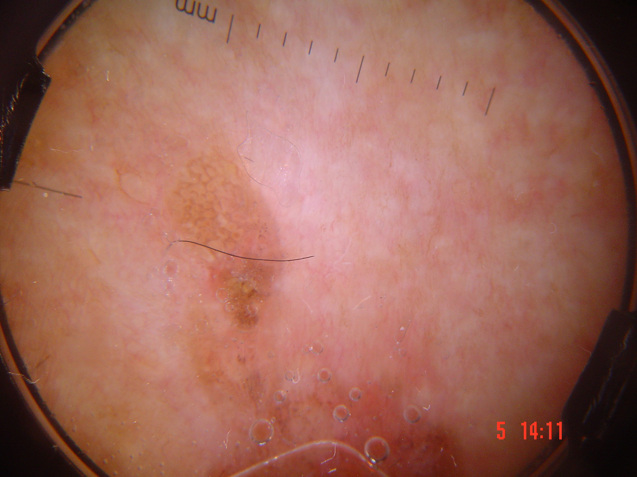 Feature exemplar: White structureless area and hairpin vessels in well-differentiated SCC