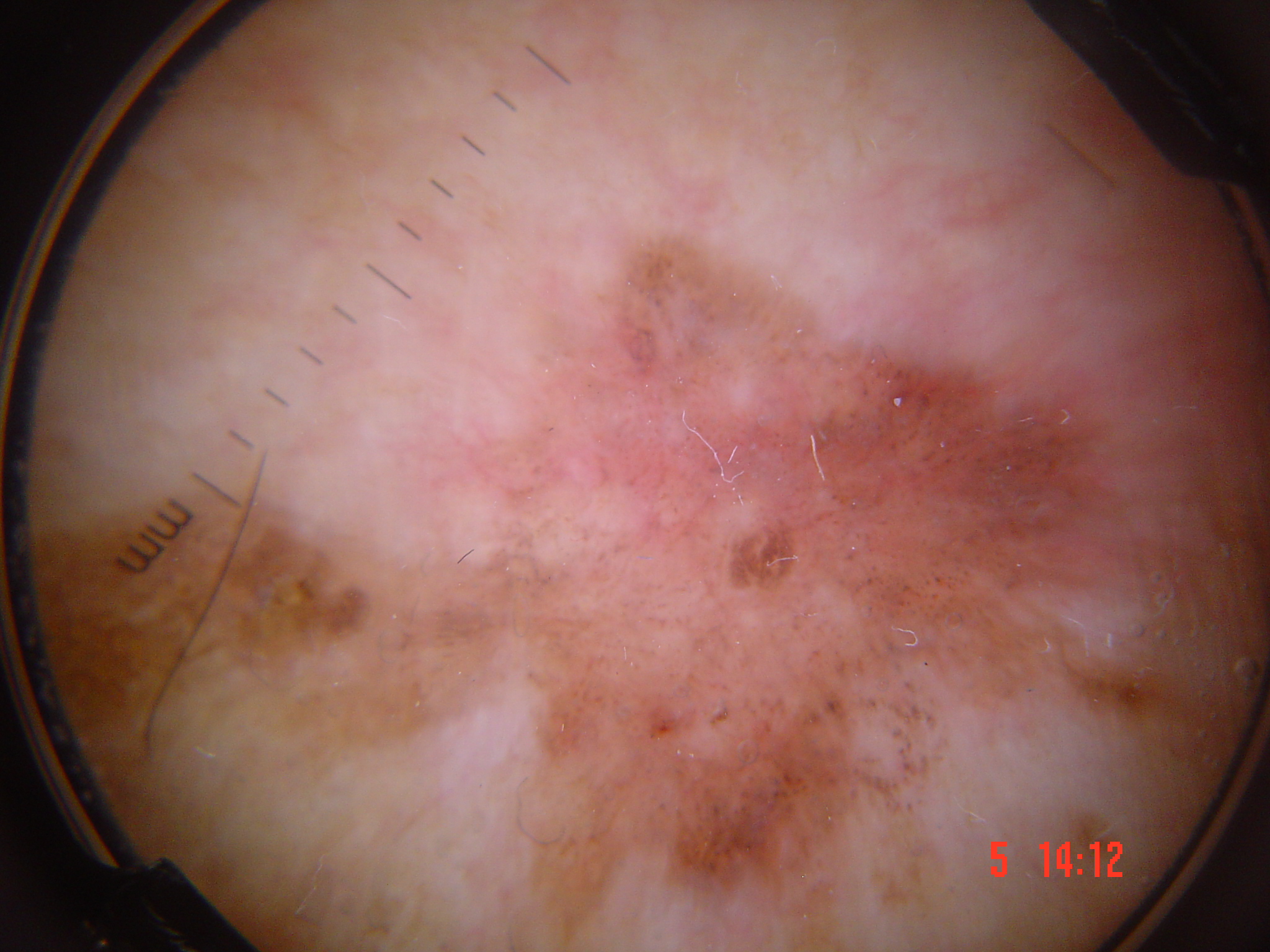 Feature exemplar: Glomerular (coiled) vessels in Bowen disease (SCC in situ) arranged in clusters