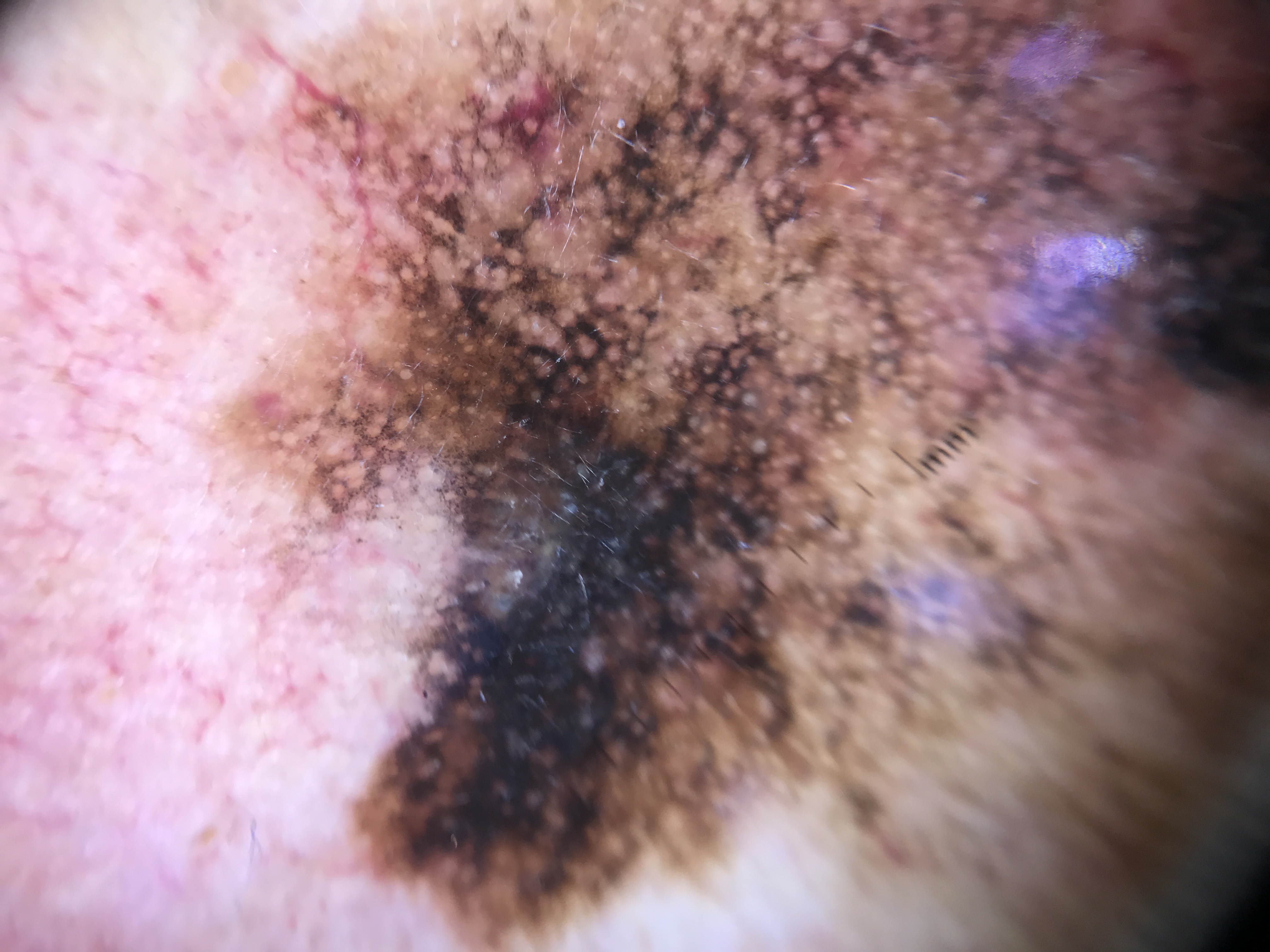 Clinical vignette: An 80-year-old man presents with multiple yellowish papules on his forehead. Dermoscopy of one lesion reveals peripheral serpentine vessels that radiate toward but do not cross the