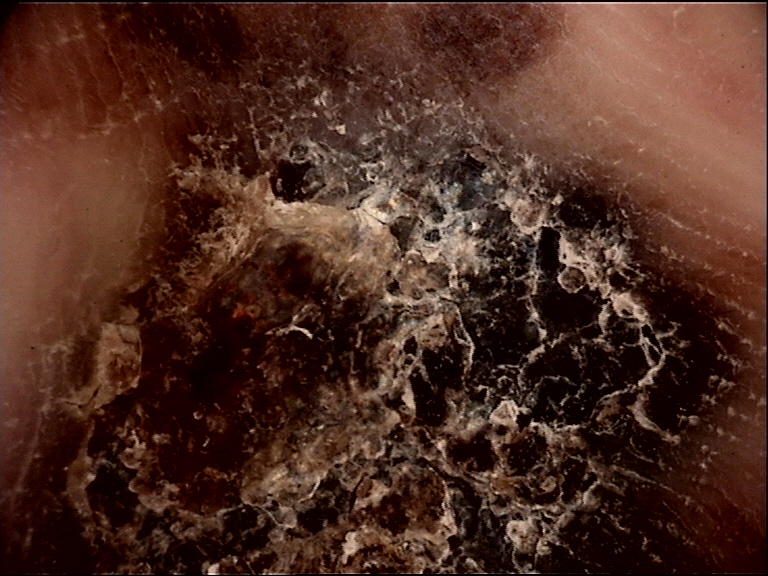 Clinical vignette: A 42-year-old woman presents with a dark spot on the ball of her right foot that appeared after a long-distance run. Dermoscopy reveals reddish-black globules with smooth margins (