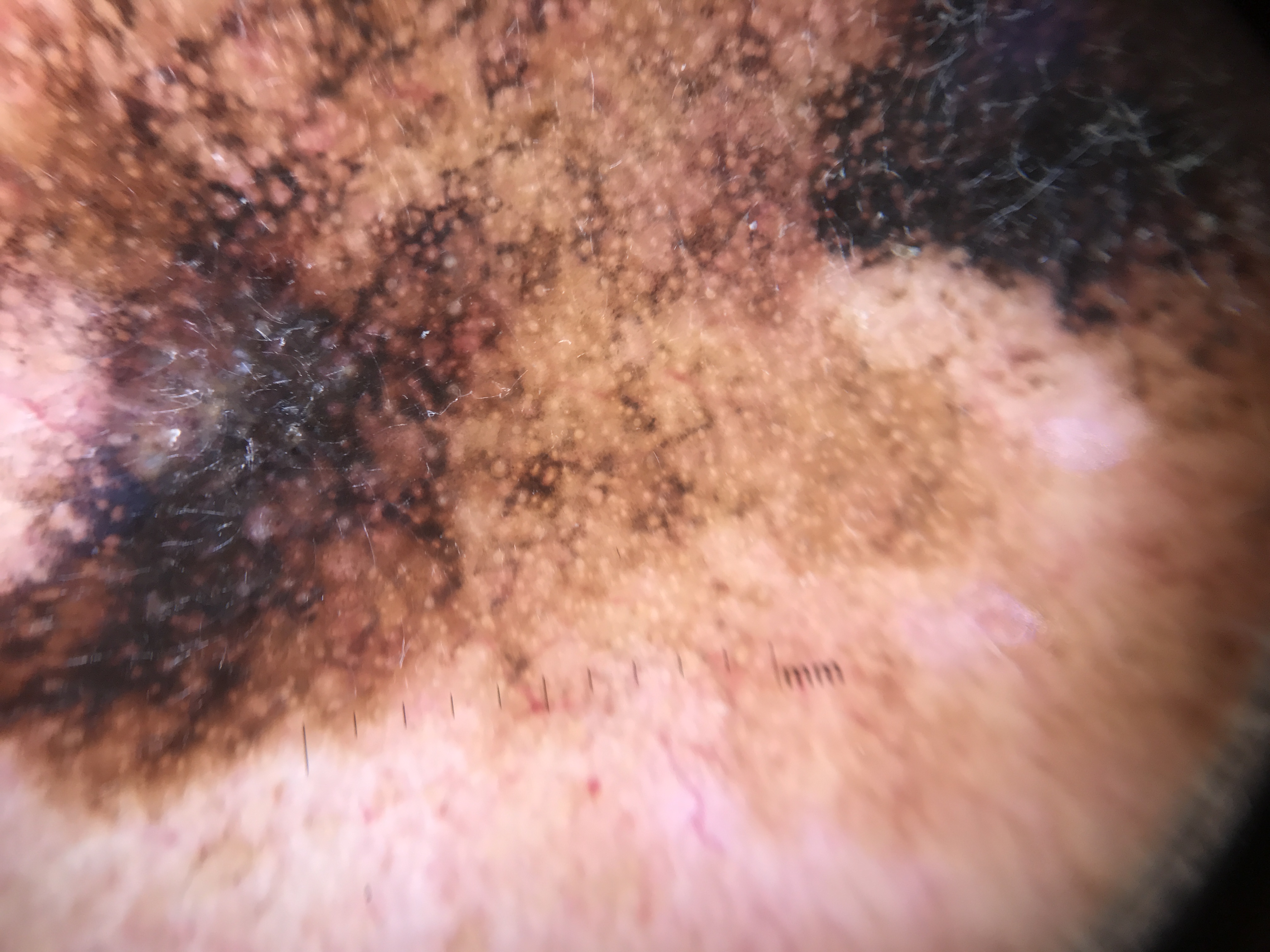 Assessment image: A 72-year-old woman presents with a slowly enlarging brown macule on her left cheek. Dermoscopy reveals small circles (follicular openings) surrounded by pigment with gray dots and