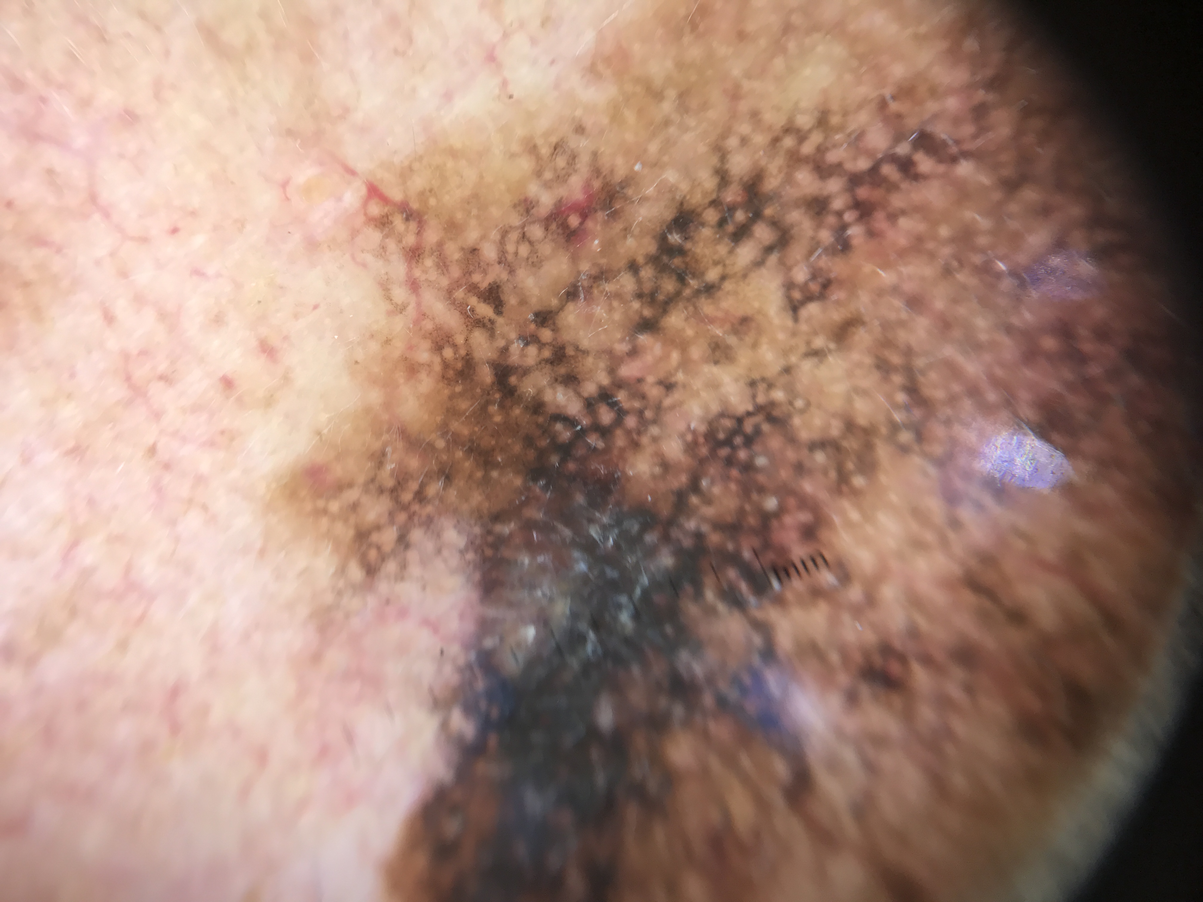 Lentigo maligna melanoma with invasion showing target-like structures and regression features