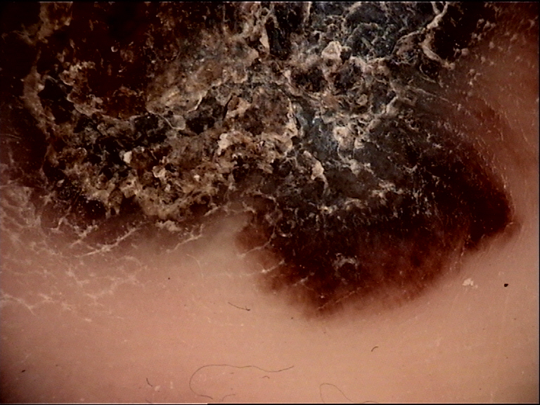 Clinical vignette: A 70-year-old man has a pigmented lesion on his sole. Dermoscopy shows a parallel ridge pattern, an irregular blotch, and asymmetry of both structures and colors. No parallel furro