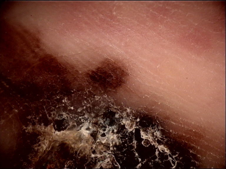 Clinical vignette: A 62-year-old man presents with a 9 mm pigmented lesion on his right great toe pad that has darkened over the past 6 months. Dermoscopy shows diffuse brown-to-black pigmentation pr