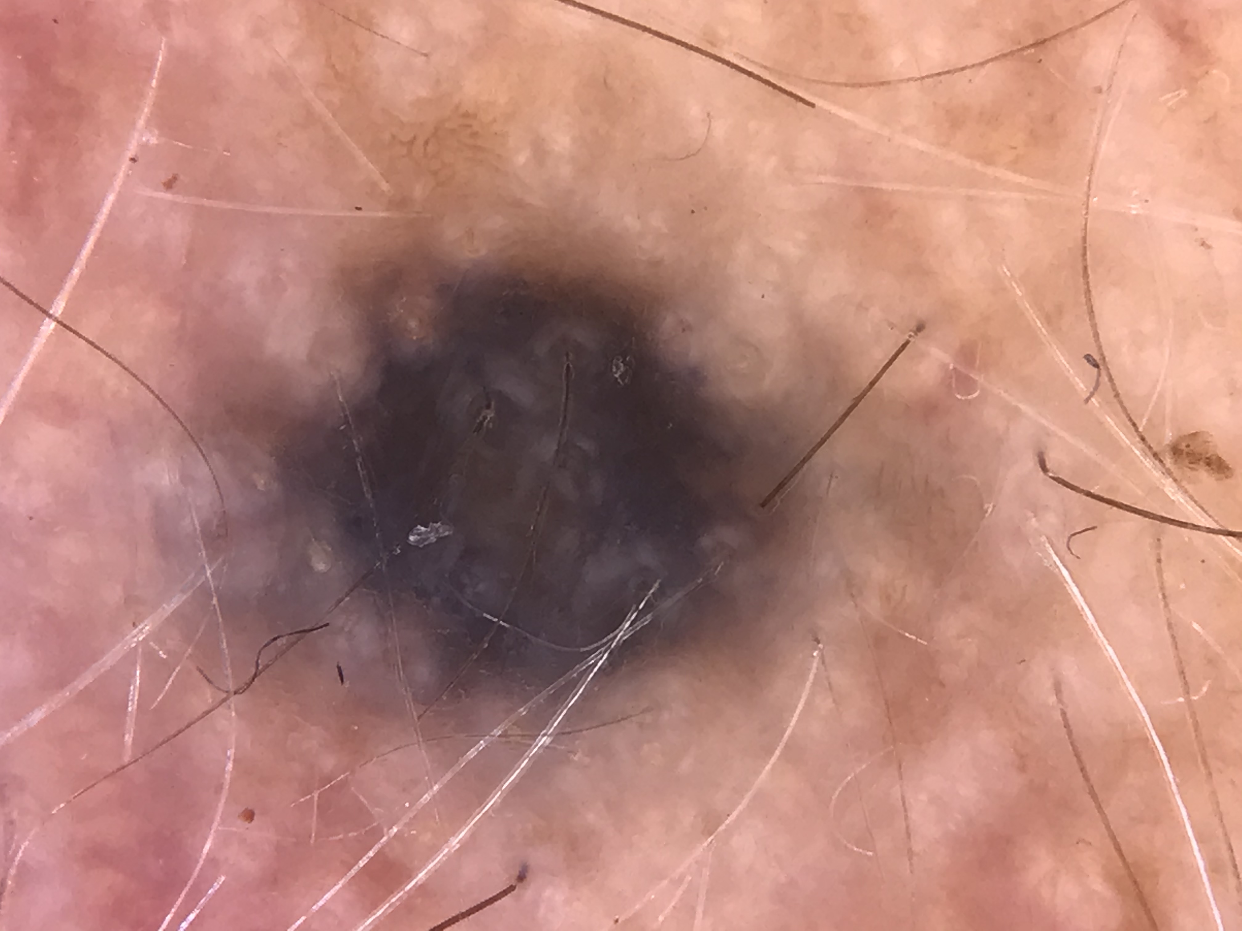 Homogeneous blue pattern in a blue nevus with dense dermal pigmentation