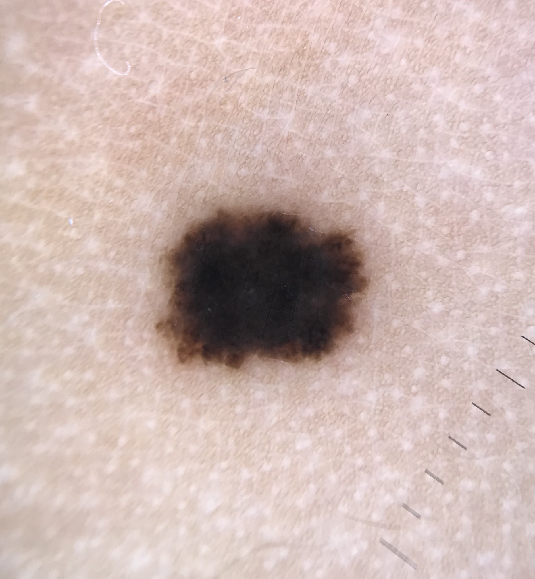Spitz nevus with negative network pattern showing grid-like reticular depigmentation