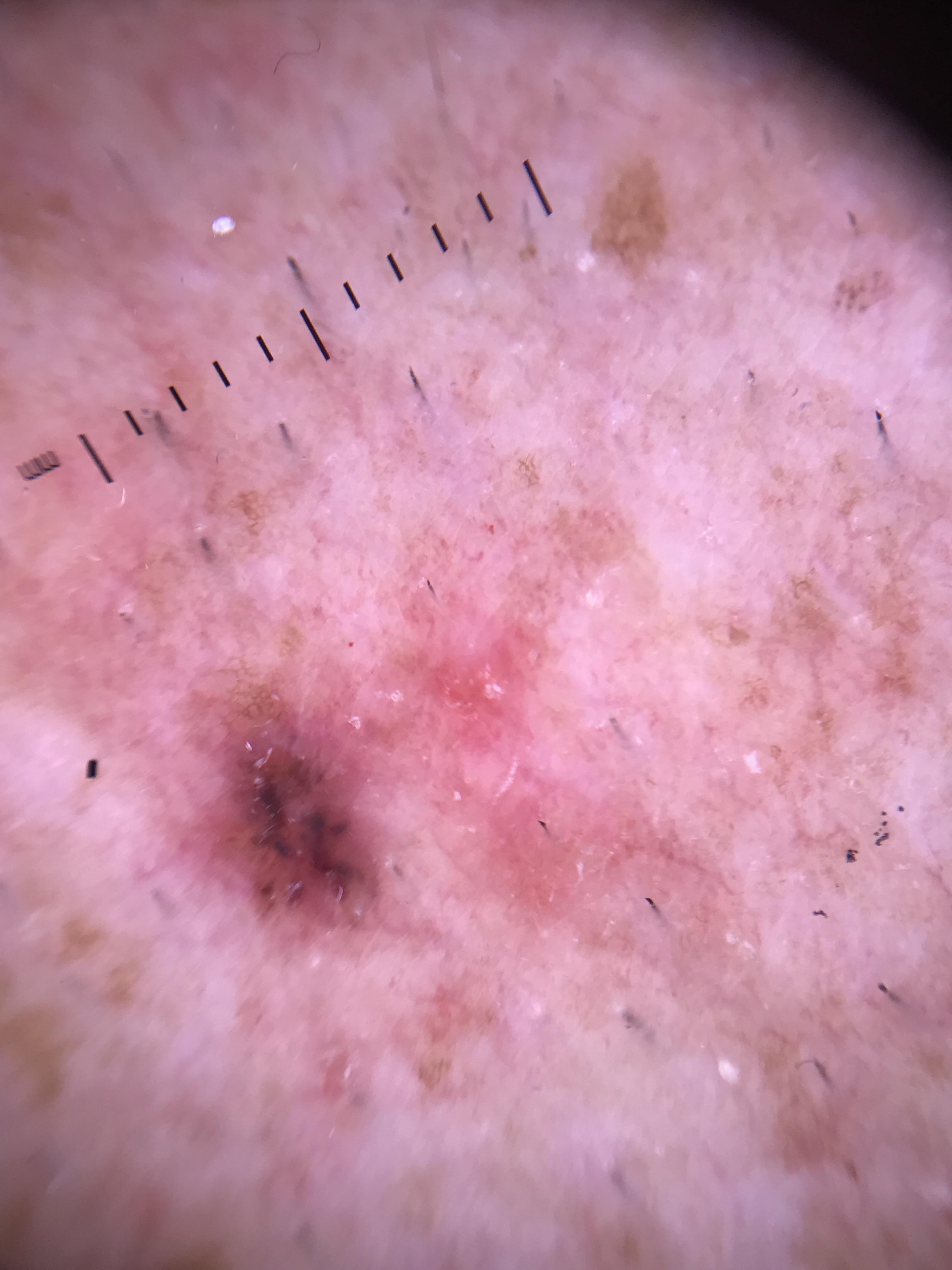 Shiny white structures under polarized dermoscopy showing lines, blotches, and rosettes