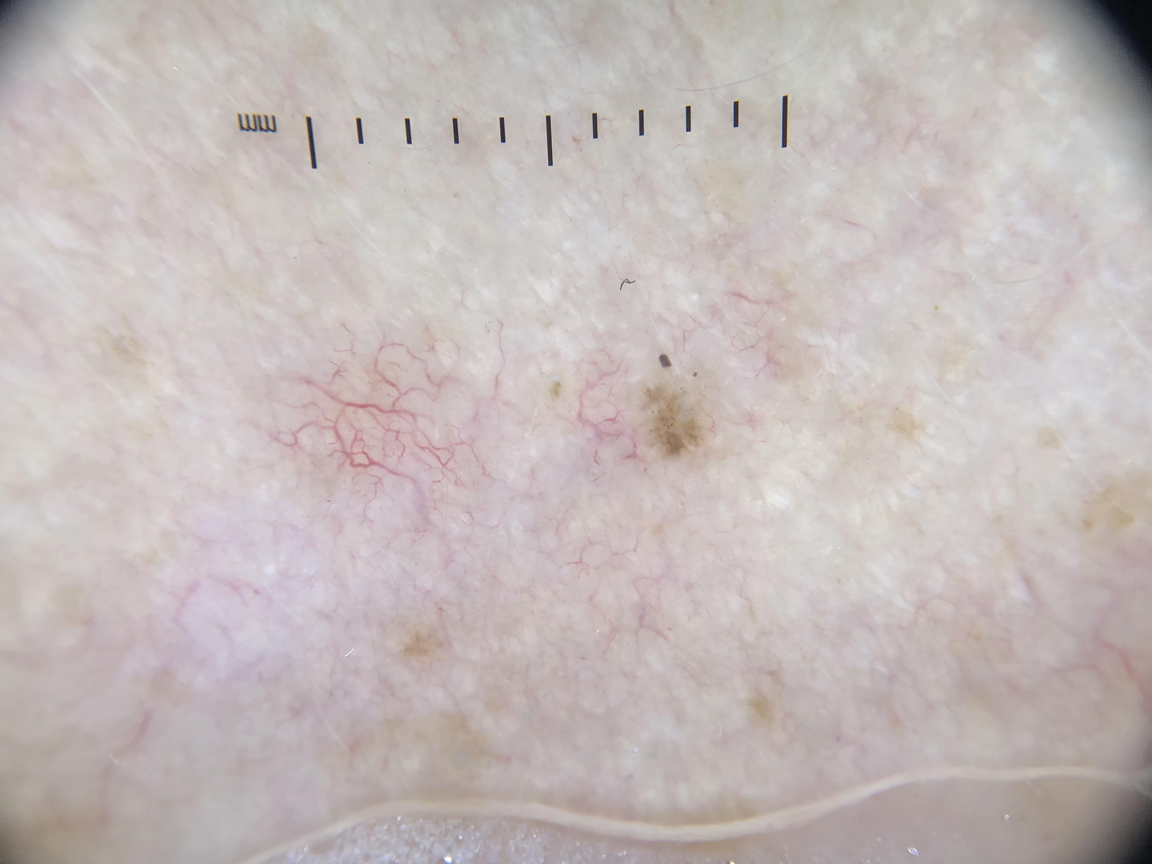 Feature exemplar: Vascular structures in dermoscopy with corresponding histologic vessel patterns