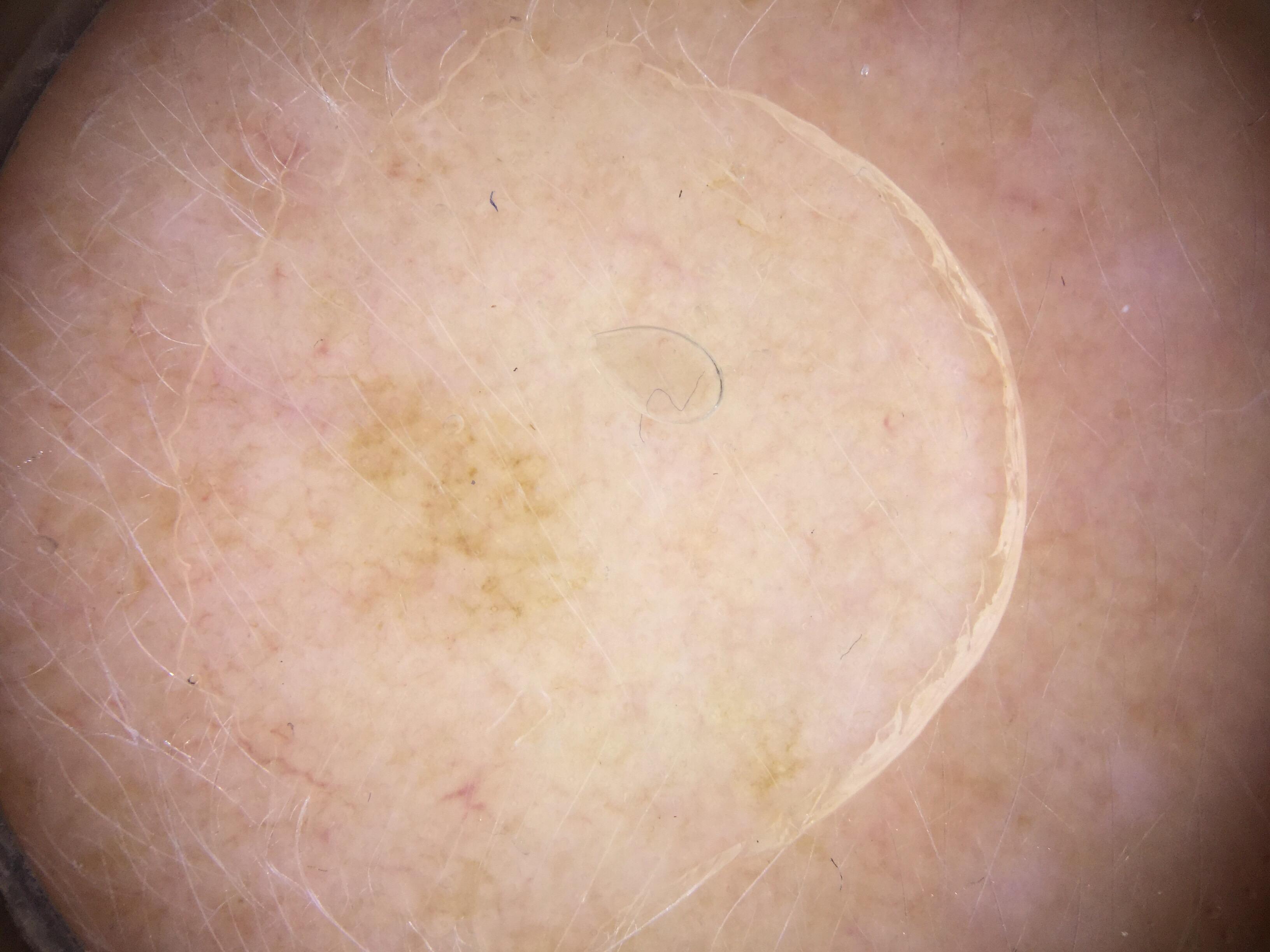 Melanocytic nevus-SK collision with atypical pigmented network on one side and cerebriform pattern on other