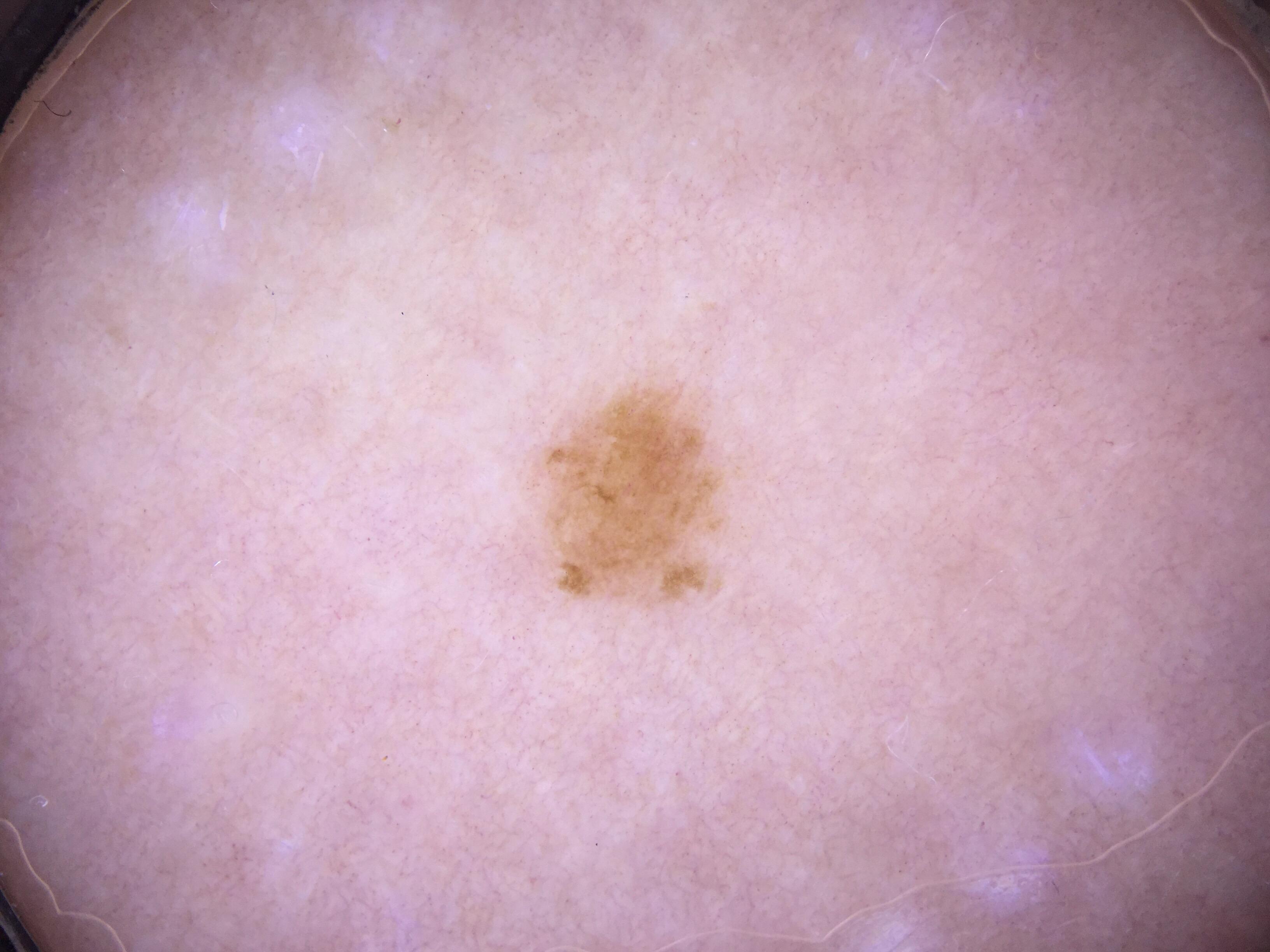 Amelanotic melanoma diagnosed by integrating melanoma risk, photographic change, and irregular vessels